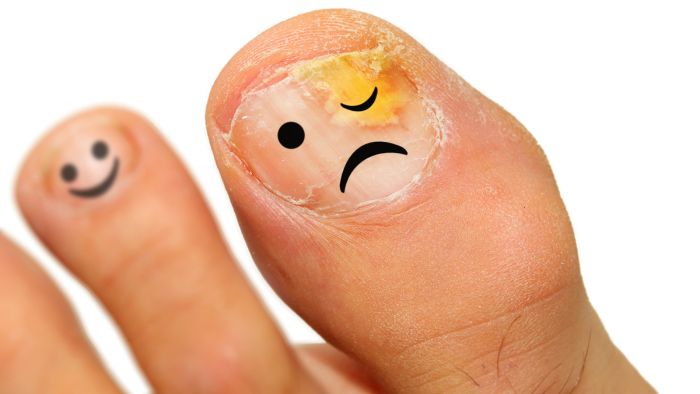 Banishing Nail Fungus: A Comprehensive Guide